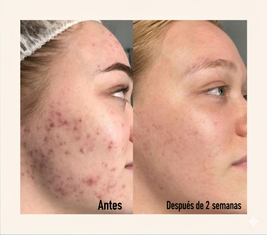Máscara LED Facial de Fototerapia